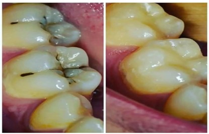 Conservative Dentistry