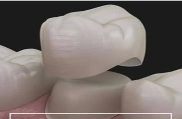 Teeth Restoration